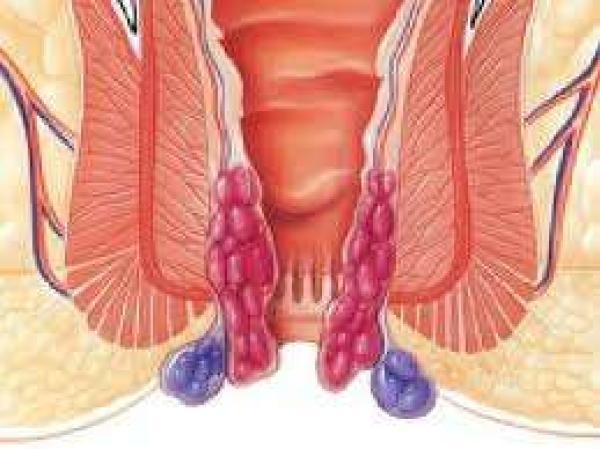 Hemoroidal Hastalık (Basur)